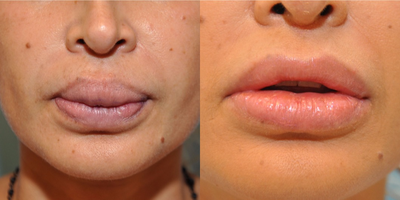 35-44 year old woman treated with Lip Reduction - 37 year old female with large upper lip from Silicone treated with Upper Lip Reduction.