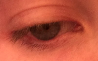 How Can I Reduce The Scar Tissue On My Bottom Eyelid Left From 