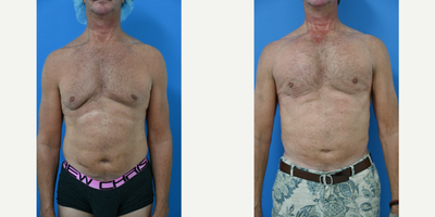 55-64 year old man treated with Pec Implants - 57 year old male from Sarasota, Florida only 4 weeks after correction gynecomastia, pectoral implants and liposuction performed by Dr Sam Gershenbaum. This patient was unhappy and self conscious about his gynecomastia, the excess fat of his back and waist as well as his lack of shape and projection of his chest even though working out with weights. This patient underwent correction of his gynecomastia, liposuction of his back and waist as well as under the muscle placement of custom extended soft, solid silicone vertical rectangular pectoral implants. He has a whole new and improved look and shape, and could not be happier with his results.
