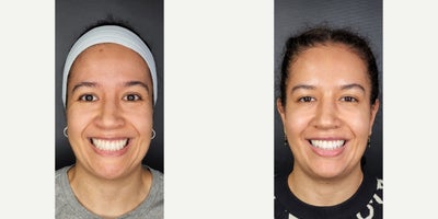 35-44 year old woman treated with Botox, Skin Rejuvenation, Dysport - Botox injection in frontalis, glabella and crow's feet