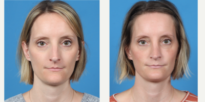35-44 year old woman treated with Rhinoplasty - Rhinoplasty