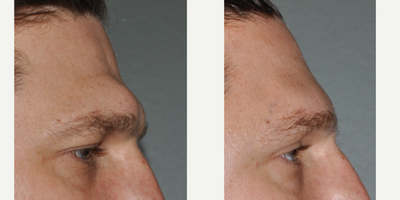 25-34 year old man treated with Facial Reconstructive Surgery - Osteoplastic brow bone reduction technique through scalp incision.