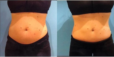 Woman treated with CoolSculpting - Non surgical results. This patient is one year post baby and had one session of coolsculpting done on the abdomen.