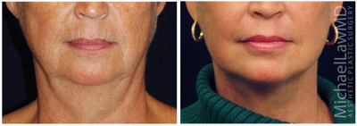 Facelift - 
	Lower Facelift

