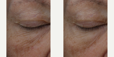 Skinbetter Science - InterFuse Intensive Treatment Cream Eye.Photo provided courtesy of Skinbetter Science.