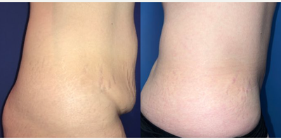 Woman treated with Tummy Tuck - Starting off our week with this gorgeous before + after #tummytuckI was not only able to achieve a flatter tummy but also a more contoured shapeTired of stubborn belly fat? Book your complimentary consultation now and lets achieve your dream body together!