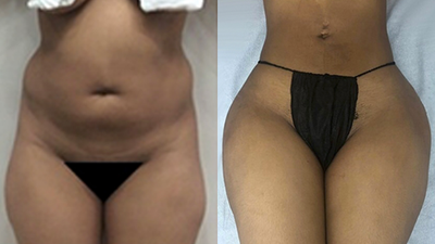 35-44 year old woman treated with Liposonix - Liposonix before and after