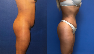 35-44 year old woman treated with Mommy Makeover - Mom to MILF Makeover Including a Tummy Tuck and BBL