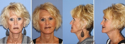 Revision Facelift and Filler  - This patient had her first facelift 6 years ago. &nbsp;As she continued to age her main concerns were skin laxity around the jawline and neck area, as well a hollow cheek area. When she was ready for a revision facelift she wanted to make sure she found a facial plastic surgeon that could help her achieve her result while keeping a very natural look. &nbsp;Dr. Kevin Sadati performed his Natural Lift, a lower face and neck lift procedure, under local anesthesia and oral sedation. &nbsp;During the procedure he also used some filler to help with the hollowness in the patient's face.&nbsp;