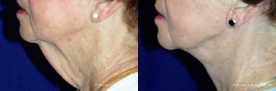 Neck Lift - 	The necklift procedure has removed the excess skin from this patient. The skin was elevated and tightened after tightening up the neck muscle. The excess skin was removed and the patient now has a dramatic, smoother neckline.
