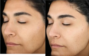 18-24 year old woman treated with Acne Treatment - SkinMedica Peel, Retin-A and Lytera