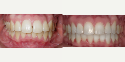 25-34 year old woman treated with Damon Braces - Invisalign with inter-proximal reduction to retract the teeth.