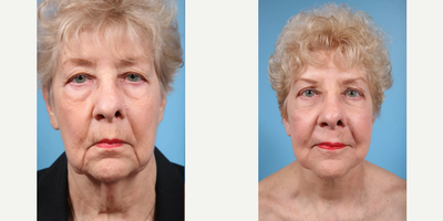 79 year old woman treated with Brow Lift, Eyelid Surgery - 79 year old woman treated with Brow Lift, Eyelid Surgery