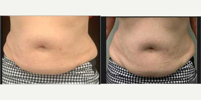 Woman treated with truSculpt - Woman treated with truSculpt.