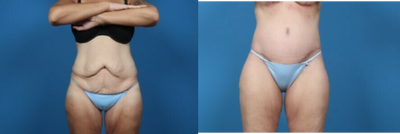 35-44 year old woman treated with Body Lift - circumferential abdominoplasty, over 100 pound weight loss