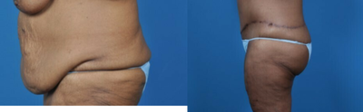 55-64 year old woman treated with Body Lift - circumferential abdominoplasty