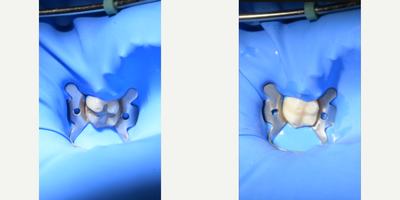 18-24 year old woman treated with Dental Bonding - Composite bonding. Amalgam remotion and composite bonding.