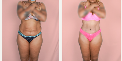 25-34 year old woman treated with Vaser Liposuction - This wonderful patient underwent a tummy tuck and flank liposuction procedure. She is shown 1 month post-op.