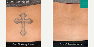 35-44 year old woman treated with PicoWay - PicoWay laser for removing unwanted tattoo