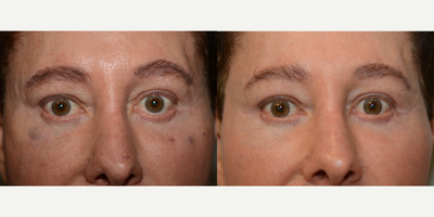 65-74 year old man treated with Eyelid Retraction Repair - This is a 65 year old man who was unhappy with his eyelid asymmetry after prior surgery elsewhere. His left lower eyelid was pulled down (retraction) which made his left eye seem bigger than the right. The doctor performed scarless lower eyelid retraction repair by placing a graft from his mouth inside his lower eyelid, thus elevating it to a natural position.