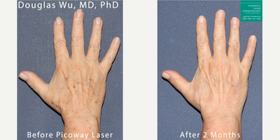 65-74 year old woman treated with PicoWay - PicoWay laser used to remove brown spots and sun damage from the backs of the hands