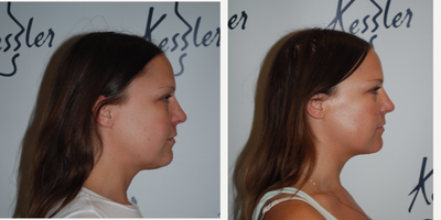 25-34 year old woman treated with Kybella - Patient concerned about submental fullness and received 3 (1 vial) treatments of Kybella spaced 6 weeks apart.