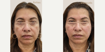 Woman treated with Skin Rejuvenation - Truly magical threads Tensor threads are absorbable sutures whose function is to give support to tissues and activate collagen; defining and granting your face a natural treasureRejuvenate your face and eliminate facial sagging and the first signs of aging, acting as a facelift! Then reposition the soft tissues, of the face and the neck.Besides that, it is a painless and minimally invasive treatment