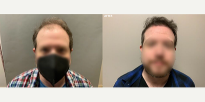 Man treated with Hair Loss Treatment - Man treated withHair Loss Treatment usingHair Transplant
