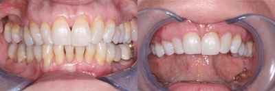 Treated with Pinhole Gum Surgery - Treated with Pinhole Gum Surgery