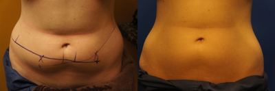 Zeltiq CoolSculpting - Zeltiq CoolSculpting