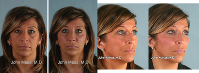 Voluma on midface / cheeks - 40 year old female that noticed her face was becoming saggy and less attractive with early aging. She wanted a non-surgical improvement of the face (mid face) with  minimal downtime. She was treated with 4 syringes of Voluma on each cheek