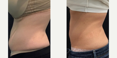 JuVaShape - Post 4 treatments, once a week, no change in diet or exercise.
