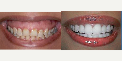45-54 year old woman treated with lip lowering - This patient's gummy smile corrected by lip lowering., in addition to veneers to improve the appearance of the teeth.