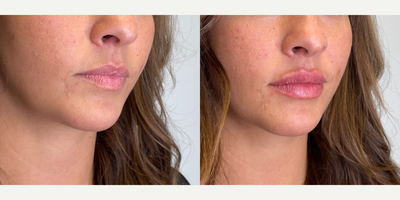 25-34 year old woman treated with Lip Fillers, Volbella - patient treated with 1 syringe of volbella