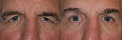 Eyelid, Male - 	Eyelid, Male