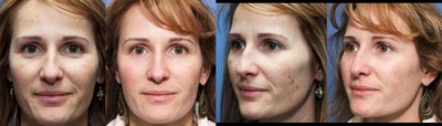 41 year old female treated for photoaging with Pixel Laser - 
	One month after first treatment

