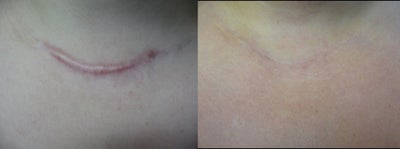 Scar Revision Procedure for Thyroid Keloid Scar on the Neck and Chest - 	The following set of before and after scar photographs represent an actual patient of Dr. Raffy Karamanoukian. The photos show a keloid scar from a surgery that began to keloid and become inflamed and red. The scar was then treated with a combination of surgical scar excision followed by pulsed dye laser vascular therapy.