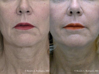 54 year old woman treated with Facelift - 54 year old woman treated with Facelift as well as fat grafting to neck area, shown 4 months post op.