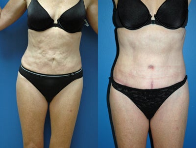 revision of liposuction - tummy tuck for over resected abdomen (liposuction)