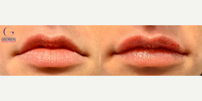 Woman treated with Lip Fillers, Restylane - Our beautiful patients concern was less volume in her upper lip. Restylane was used to enhance the upper lip and provide balance for a natural look.