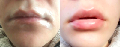 25-34 year old woman treated with Injectable Fillers - Juvederm for lip enhancement