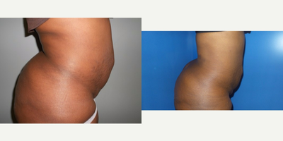 35-44 year old woman treated with Liposuction - This patient is a forty two year old female that consulted with Dr. Greenberg hoping to lose some of her stubborn belly fat. She understood that she had extra skin that will not go away with liposuction alone.  Four months post op.