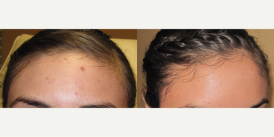 18-24 year old woman treated with Mole Removal - Mole removal using plastic surgery techniques