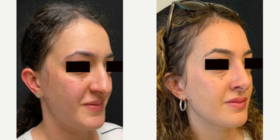 Woman treated with Rhinoplasty - Woman treated with Rhinoplasty.