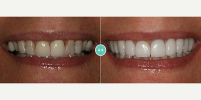 Woman treated with Porcelain Veneers - Woman treated with Porcelain Veneers