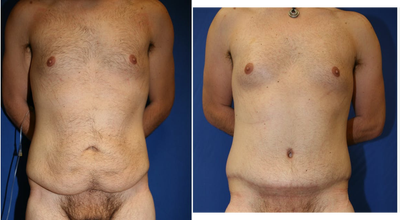 25-34 year old man treated with Tummy Tuck - This patient in his late 20's was unhappy with the excess skin of his abdomen after losing 40 pounds. He wanted to get rid of his loose skin after weight loss. Dr. Katzen performed a tummy tuck in Beverly Hills to flatten his stomach by removing the excess skin and tightening his abdominal muscles. He is extremely happy with his results.