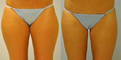 25 year old woman treated with Smart Lipo. - 25 year old woman treated with Smart Lipo of the inner and outer thighs.
