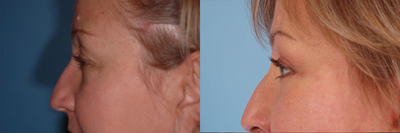 44 year old woman treated with Eyelid Surgery - A 44 year old woman before and after Upper and Lower Lid Blepharoplasty by Andrew T. Lyos M.D FACS. Her eyes demonstrated moderate asymmetry and moderate brow ptosis with dermatochalasia of the upper and lower eyelids.