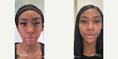 Woman treated with Facial - Woman treated with Facial