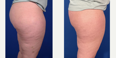 Cellulite Reduction - Cellulite Reduction 2-months following Cellfina and 16 treatments of Acoustic Wave Therapy